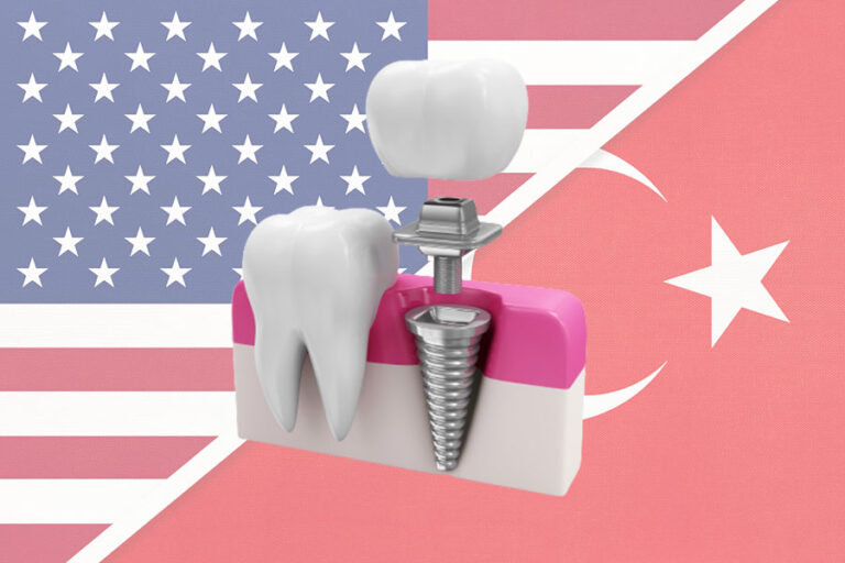 زراعة الأسنان في تركيا مقابل زراعة الاسنان في الولايات المتحدة