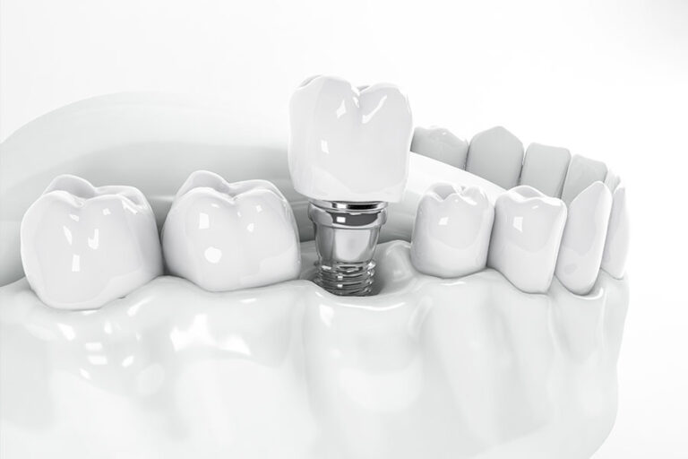 زراعة الأسنان مع تاج الاسنان في تركيا : هل هذا المزيج مناسب لك؟