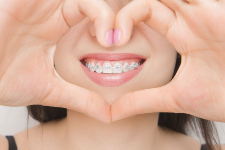 لماذا يعتبر تقويم الأسنان مهمًا؟
