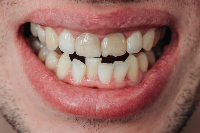 هل يمكن إصلاح الأسنان المتشققة؟